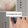 Eczema Powder