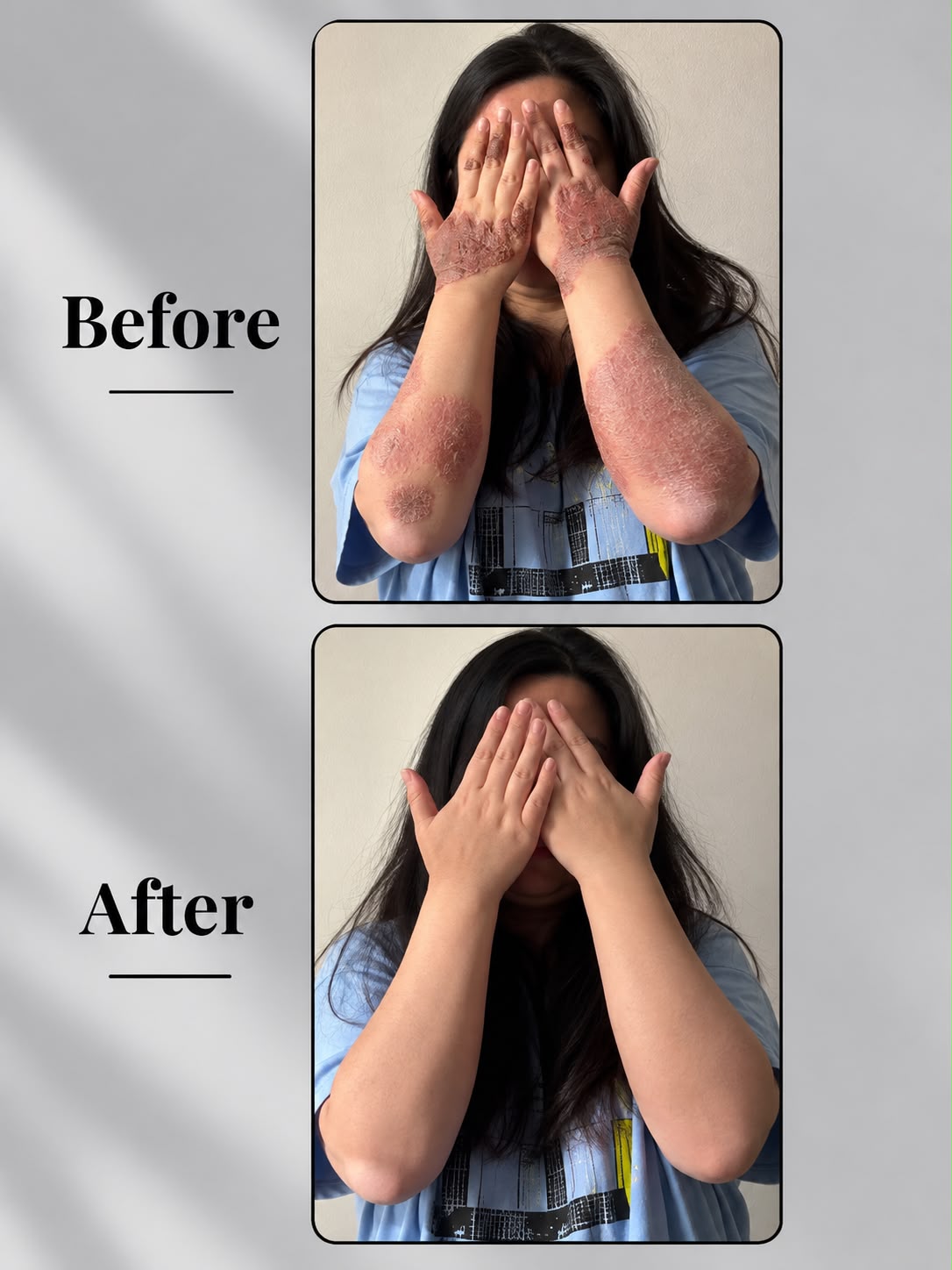 Eczema Powder