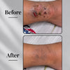 Eczema Powder