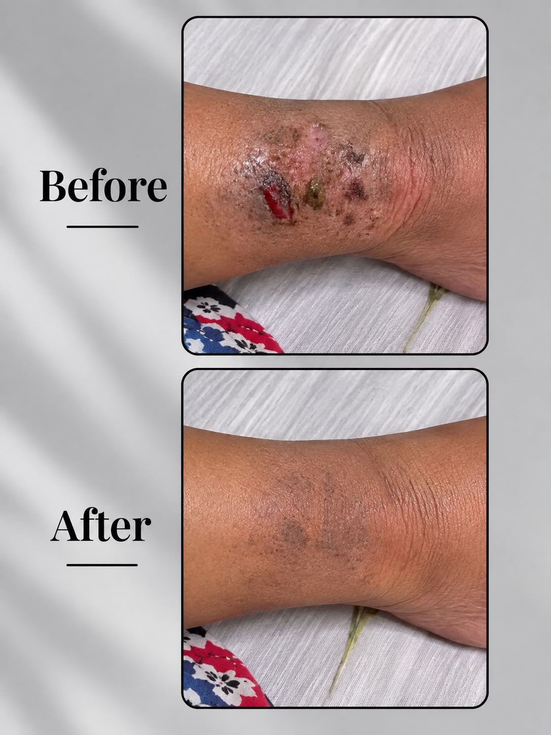 Eczema Powder