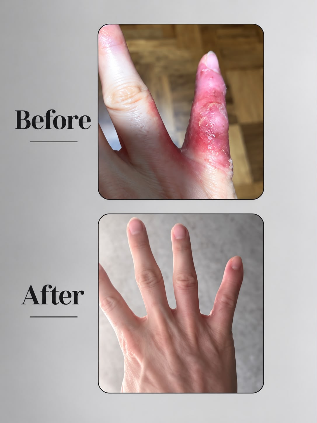 Eczema Powder