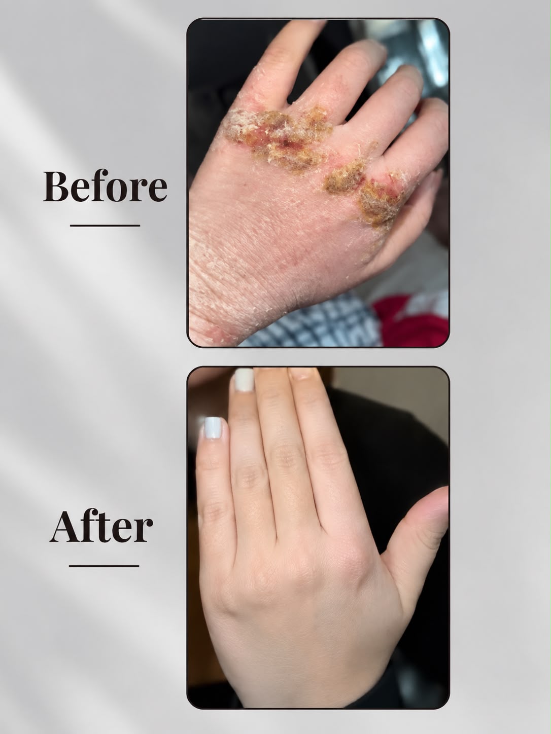 Eczema Powder