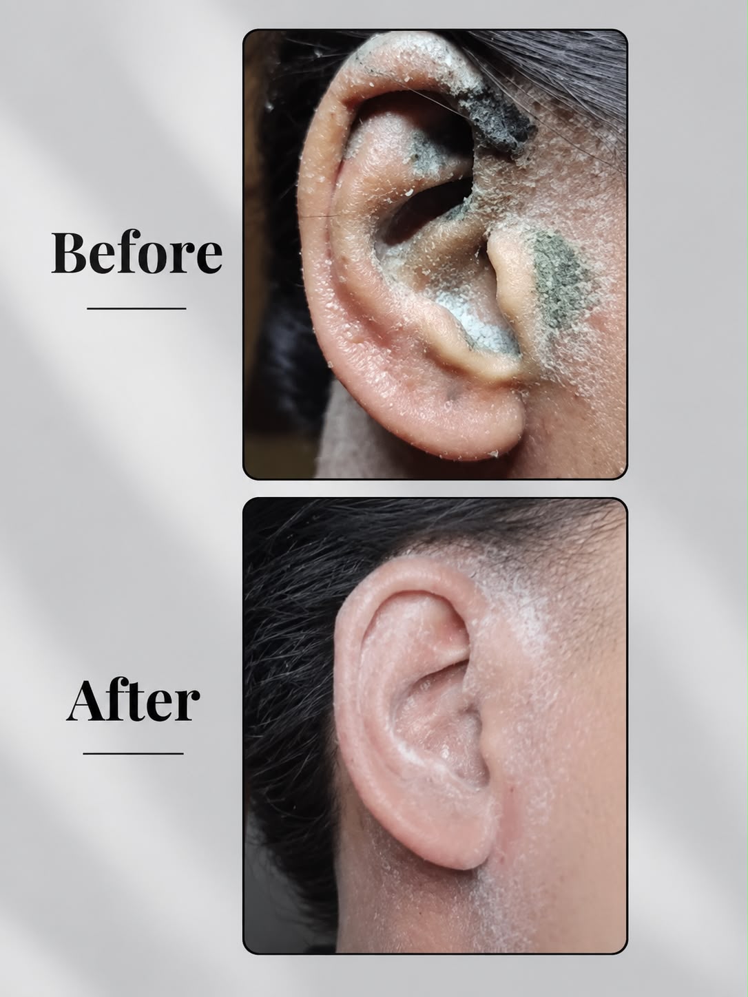 Eczema Powder