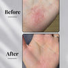 Eczema Powder