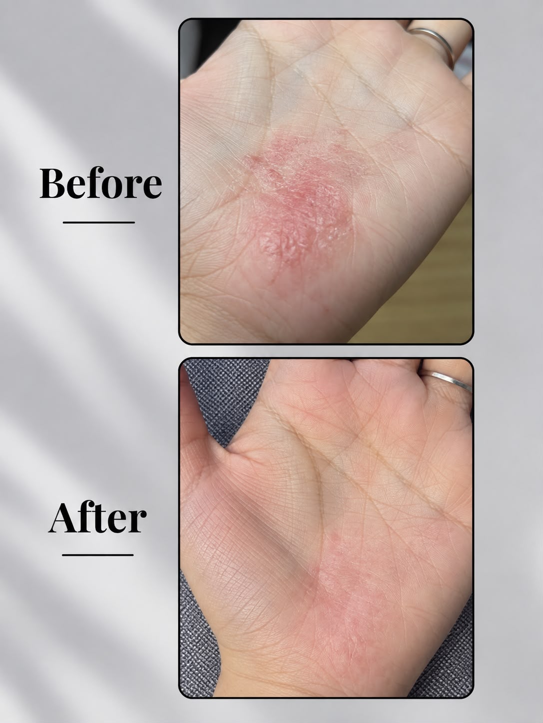 Eczema Powder